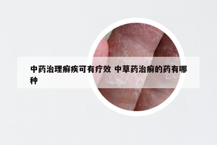 中药治理癣疾可有疗效 中草药治癣的药有哪种