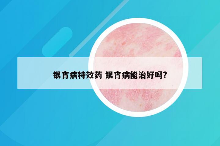 银宵病特效药 银宵病能治好吗?