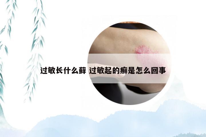 过敏长什么藓 过敏起的癣是怎么回事