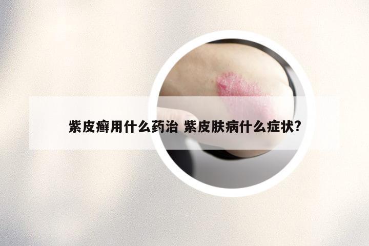 紫皮癣用什么药治 紫皮肤病什么症状?
