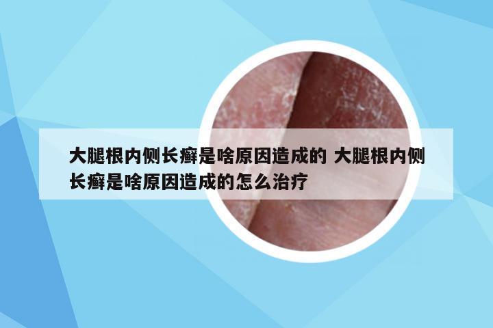 大腿根内侧长癣是啥原因造成的 大腿根内侧长癣是啥原因造成的怎么治疗