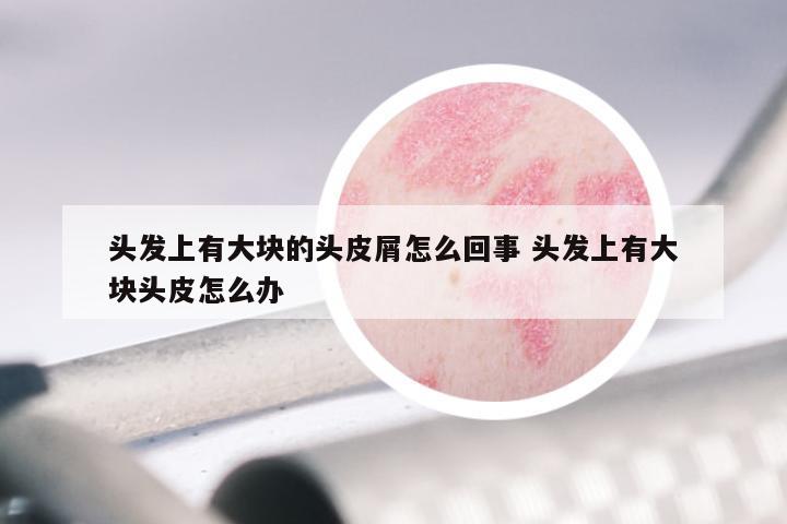 头发上有大块的头皮屑怎么回事 头发上有大块头皮怎么办