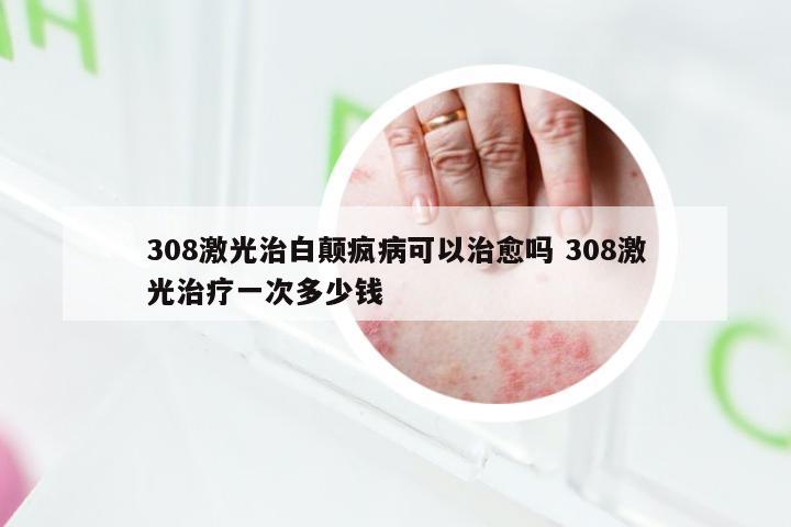 308激光治白颠疯病可以治愈吗 308激光治疗一次多少钱