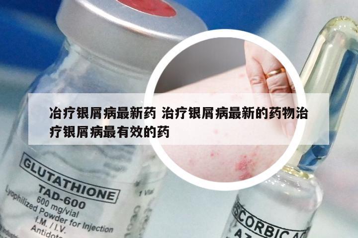 冶疗银屑病最新药 治疗银屑病最新的药物治疗银屑病最有效的药
