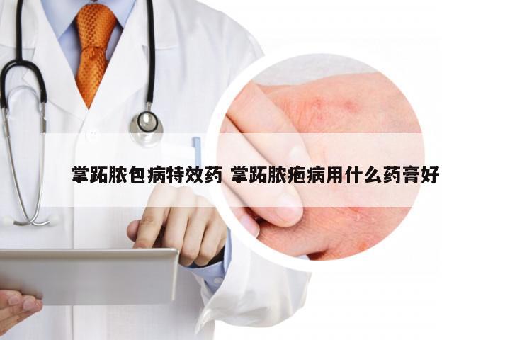 掌跖脓包病特效药 掌跖脓疱病用什么药膏好