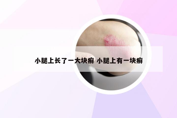小腿上长了一大块癣 小腿上有一块癣