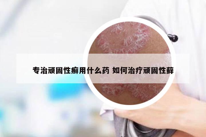 专治顽固性癣用什么药 如何治疗顽固性藓