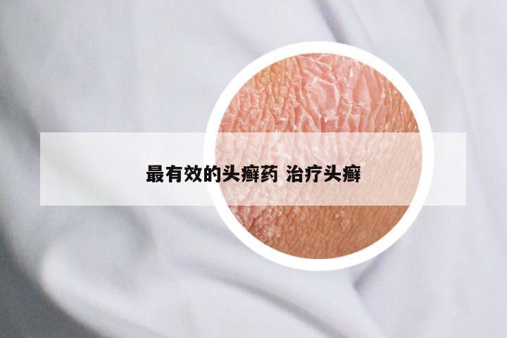 最有效的头癣药 治疗头癣