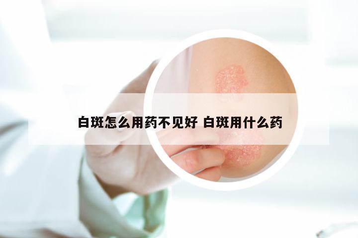 白斑怎么用药不见好 白斑用什么药