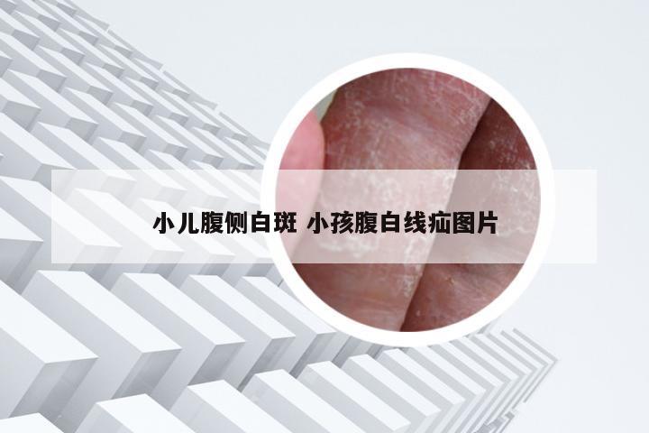 小儿腹侧白斑 小孩腹白线疝图片