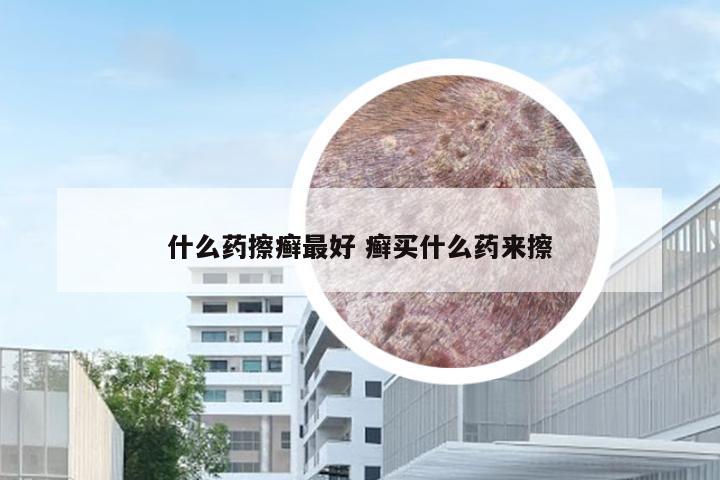 什么药擦癣最好 癣买什么药来擦