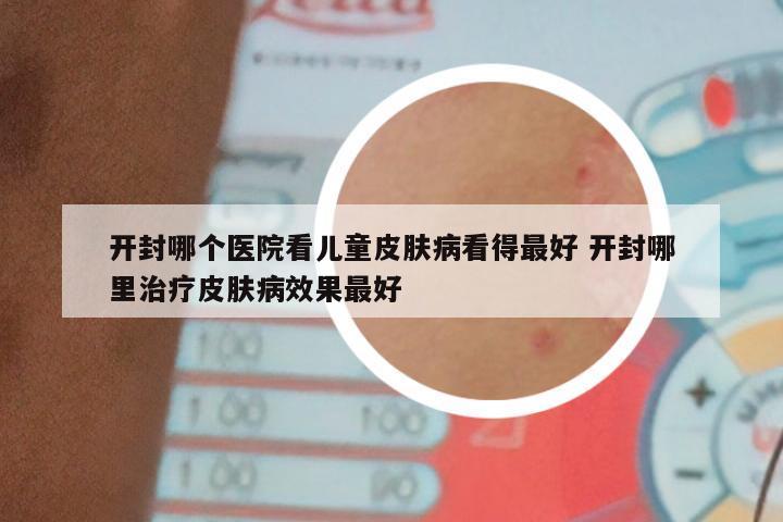开封哪个医院看儿童皮肤病看得最好 开封哪里治疗皮肤病效果最好