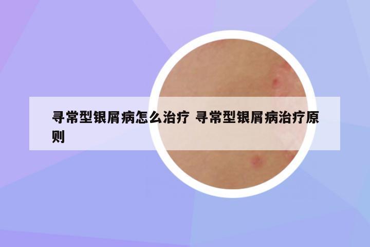 寻常型银屑病怎么治疗 寻常型银屑病治疗原则