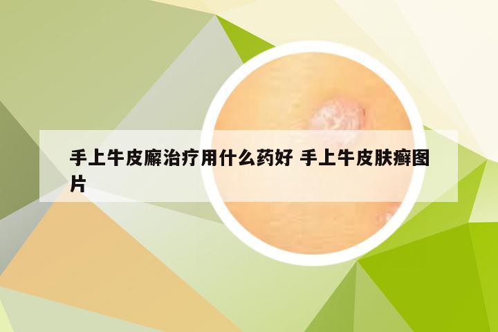 手上牛皮廨治疗用什么药好 手上牛皮肤癣图片