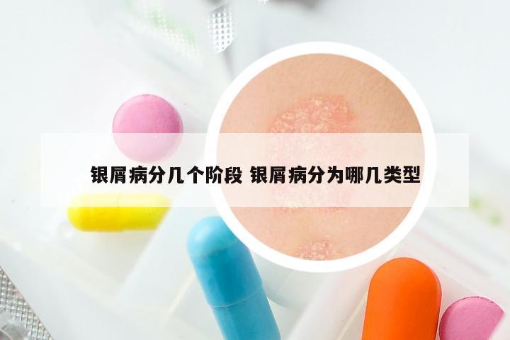 银屑病分几个阶段 银屑病分为哪几类型