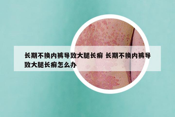 长期不换内裤导致大腿长癣 长期不换内裤导致大腿长癣怎么办