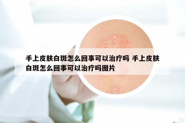 手上皮肤白斑怎么回事可以治疗吗 手上皮肤白斑怎么回事可以治疗吗图片