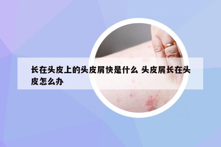 长在头皮上的头皮屑快是什么 头皮屑长在头皮怎么办