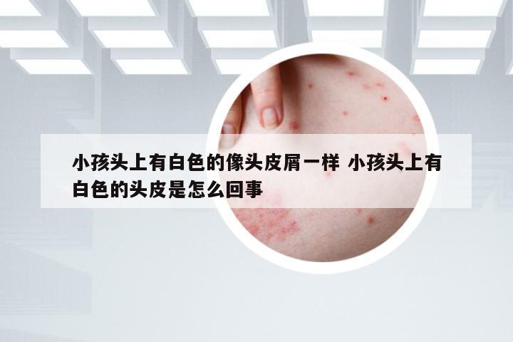 小孩头上有白色的像头皮屑一样 小孩头上有白色的头皮是怎么回事