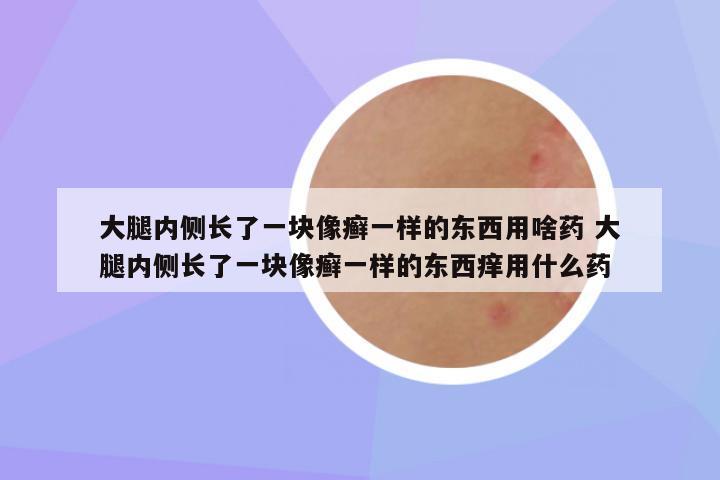 大腿内侧长了一块像癣一样的东西用啥药 大腿内侧长了一块像癣一样的东西痒用什么药