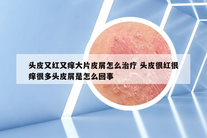 头皮又红又痒大片皮屑怎么治疗 头皮很红很痒很多头皮屑是怎么回事