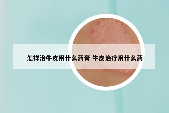 怎样治牛皮用什么药膏 牛皮治疗用什么药