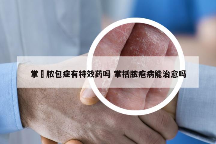 掌砋脓包症有特效药吗 掌括脓疱病能治愈吗