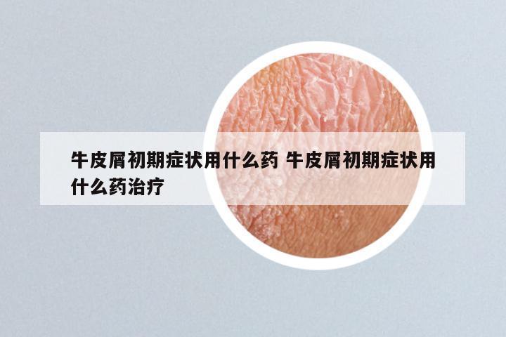 牛皮屑初期症状用什么药 牛皮屑初期症状用什么药治疗