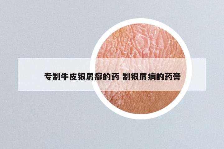 专制牛皮银屑癣的药 制银屑病的药膏