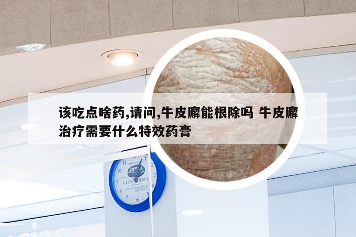 该吃点啥药,请问,牛皮廨能根除吗 牛皮廨治疗需要什么特效药膏