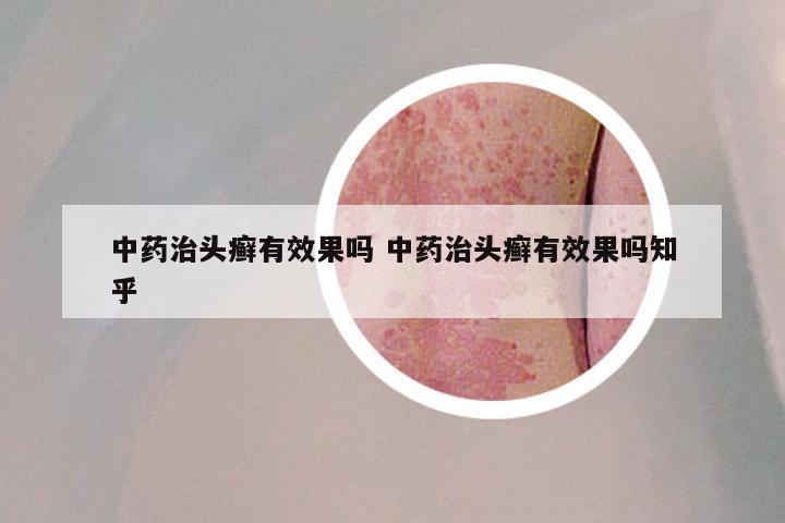 中药治头癣有效果吗 中药治头癣有效果吗知乎