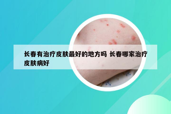 长春有治疗皮肤最好的地方吗 长春哪家治疗皮肤病好
