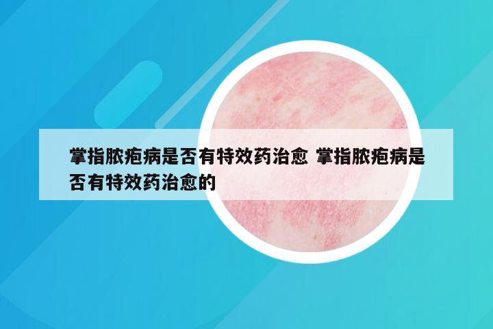 掌指脓疱病是否有特效药治愈 掌指脓疱病是否有特效药治愈的