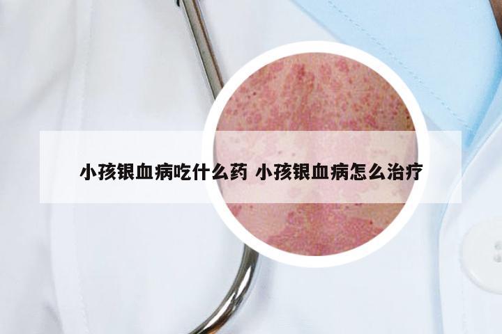 小孩银血病吃什么药 小孩银血病怎么治疗