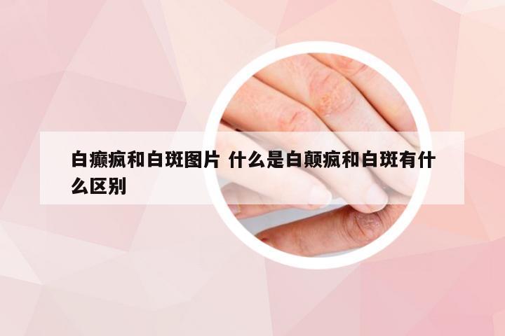 白癫疯和白斑图片 什么是白颠疯和白斑有什么区别