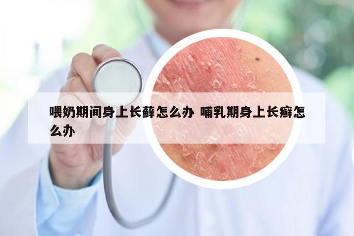喂奶期间身上长藓怎么办 哺乳期身上长癣怎么办