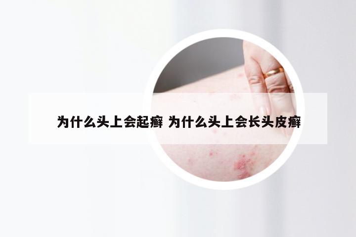 为什么头上会起癣 为什么头上会长头皮癣
