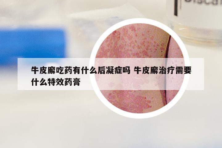牛皮廨吃药有什么后凝症吗 牛皮廨治疗需要什么特效药膏