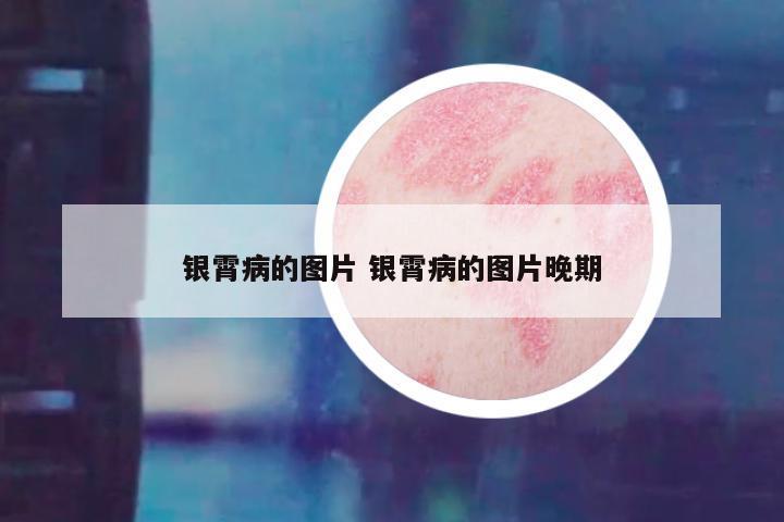 银霄病的图片 银霄病的图片晚期