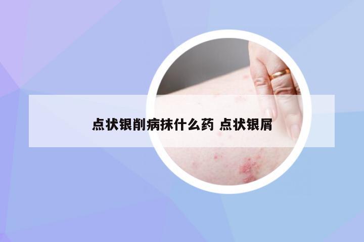 点状银削病抹什么药 点状银屑