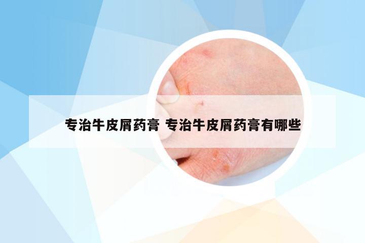 专治牛皮屑药膏 专治牛皮屑药膏有哪些