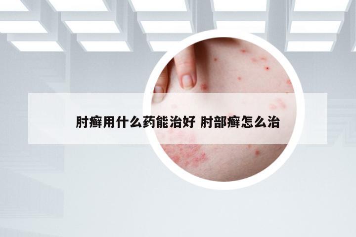 肘癣用什么药能治好 肘部癣怎么治