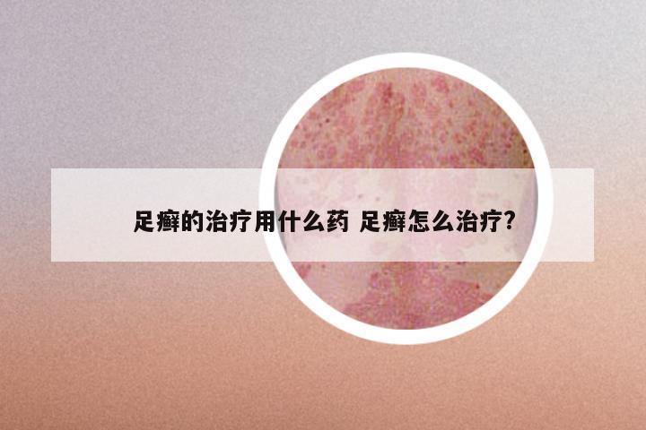 足癣的治疗用什么药 足癣怎么治疗?