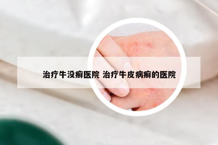 治疗牛没癣医院 治疗牛皮病癣的医院