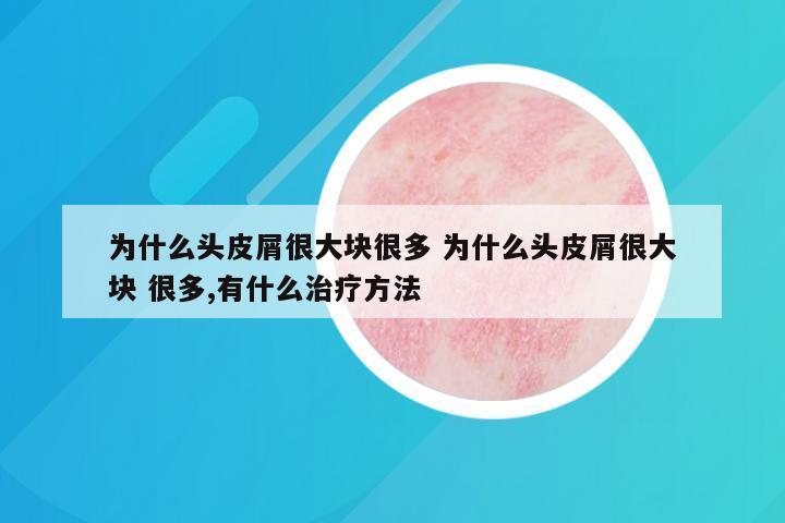 为什么头皮屑很大块很多 为什么头皮屑很大块 很多,有什么治疗方法