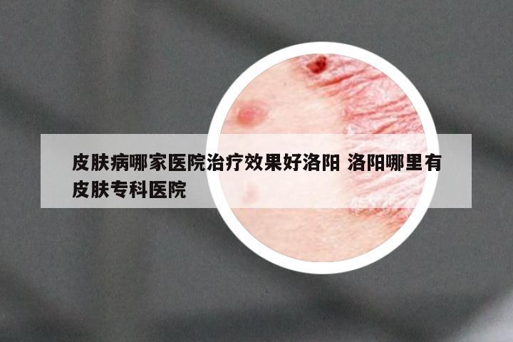 皮肤病哪家医院治疗效果好洛阳 洛阳哪里有皮肤专科医院