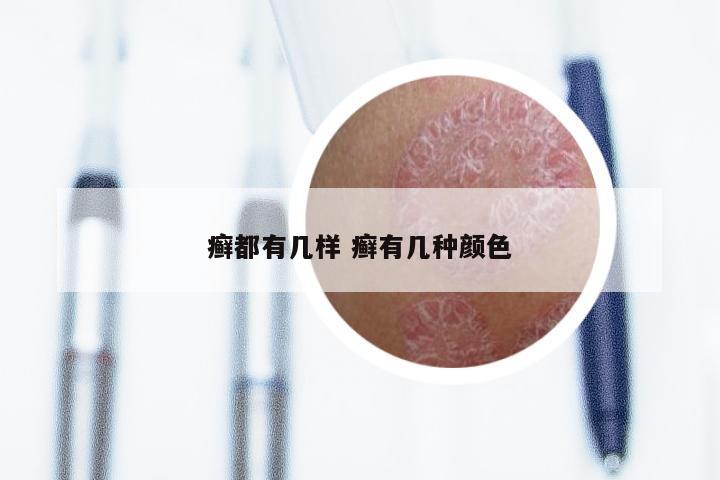 癣都有几样 癣有几种颜色