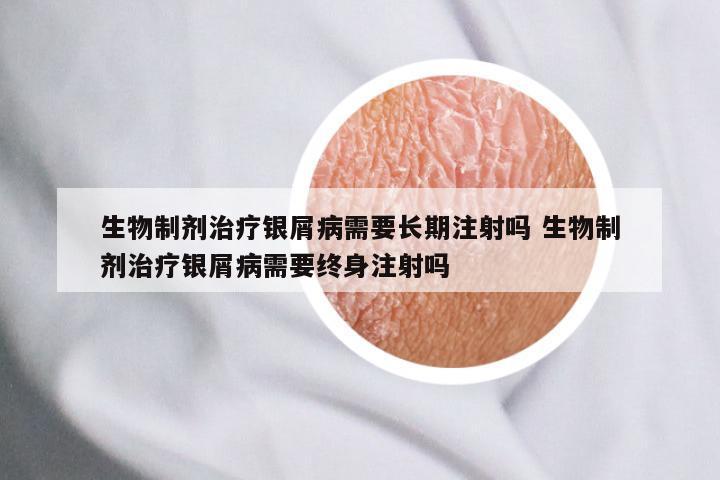 生物制剂治疗银屑病需要长期注射吗 生物制剂治疗银屑病需要终身注射吗
