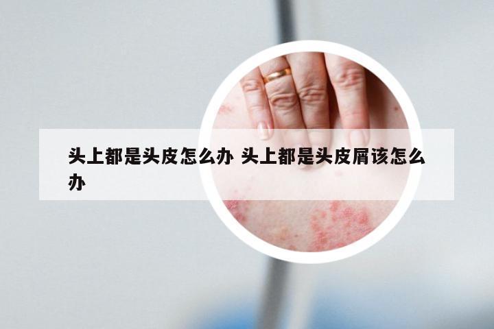 头上都是头皮怎么办 头上都是头皮屑该怎么办