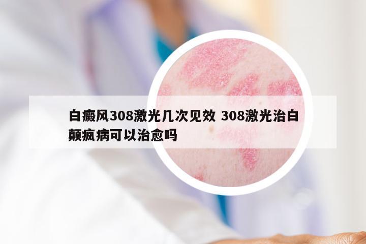 白癜风308激光几次见效 308激光治白颠疯病可以治愈吗